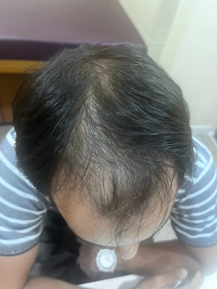 Male Pattern Baldness case 2 before treatment